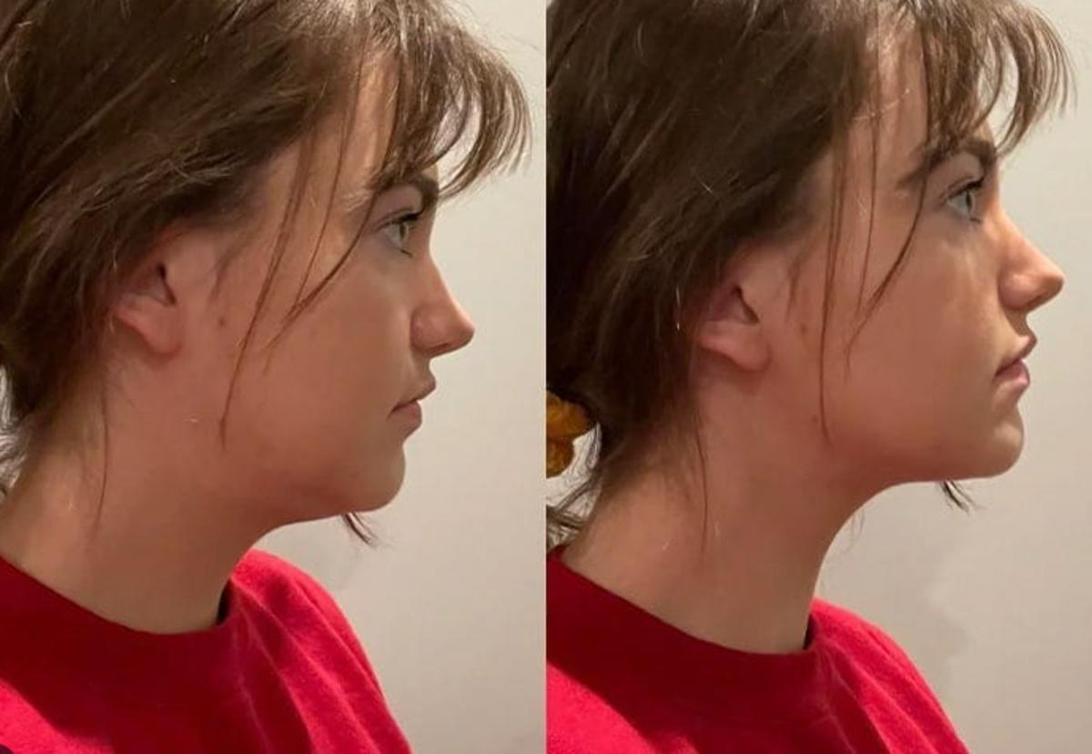 El mewing es un ejercicio viral en TikTok para eliminar la papada