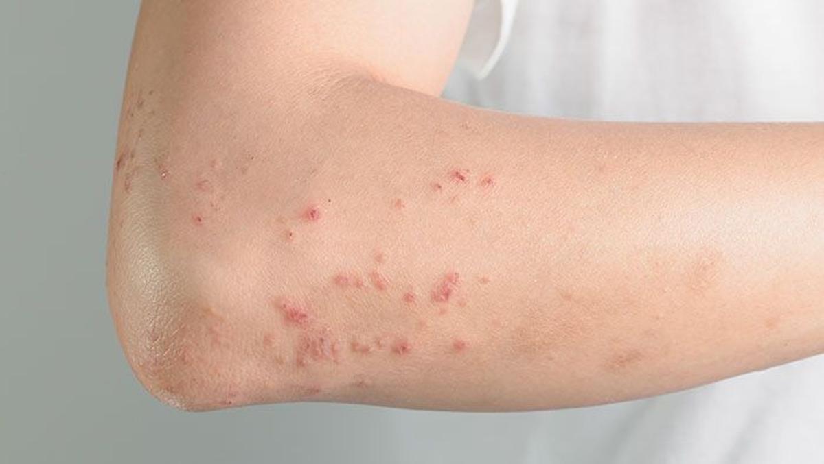Efectos de la miliaria, también conocida como sudamina o sarpullido de calor