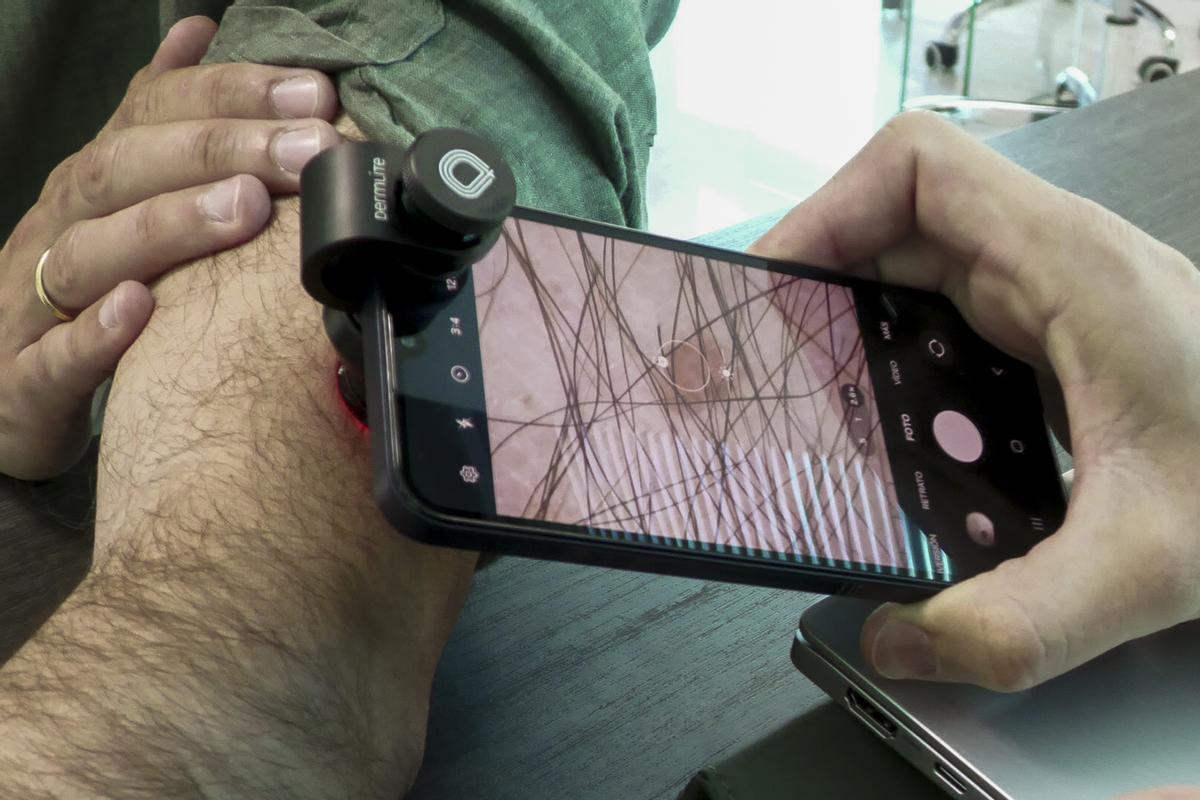El telediagnóstico, una alternativa para la detección temprana del melanoma