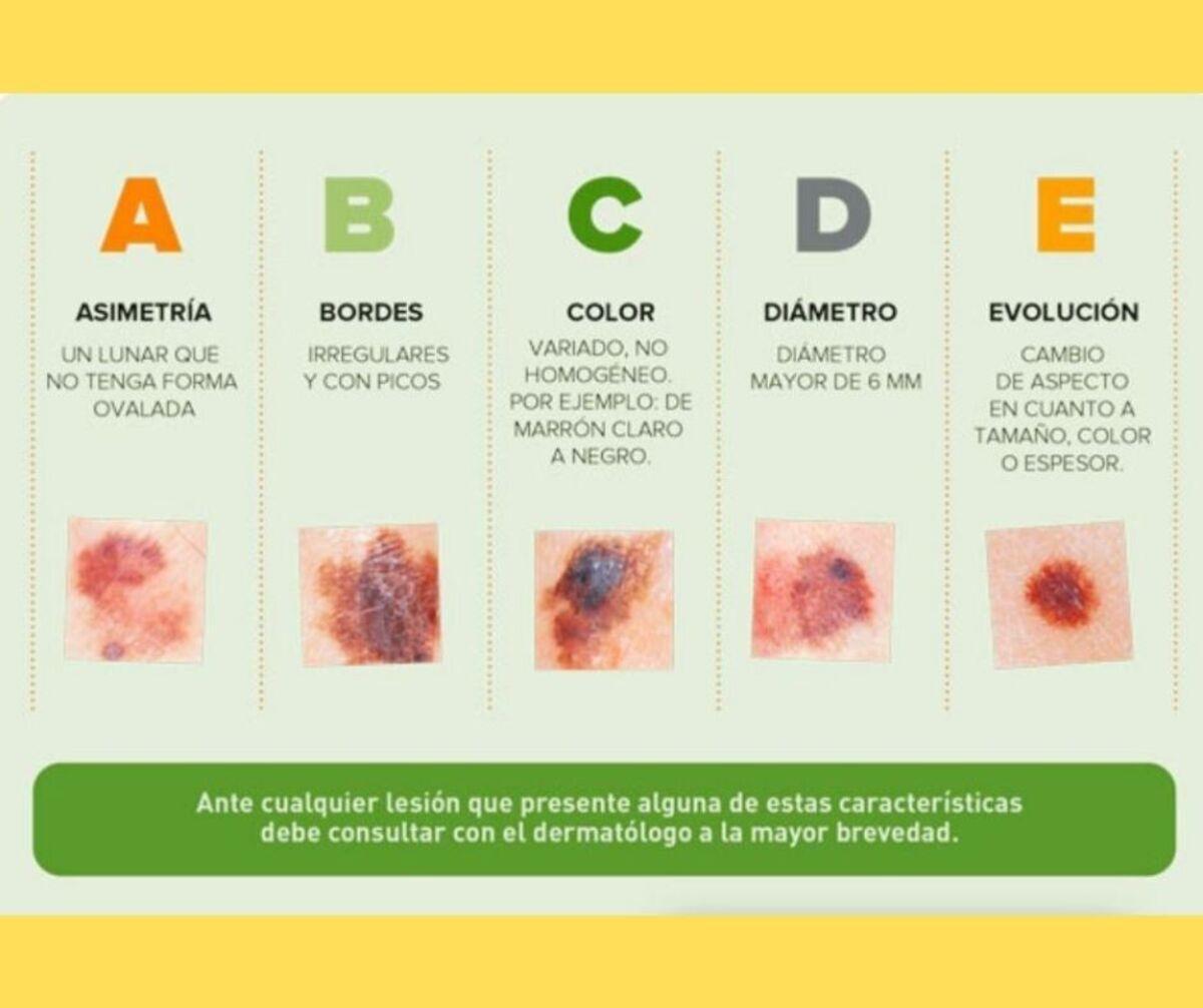 Regla ABCDE para detectar melanomas